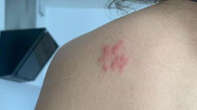 Jeder Dritte erkrankt an Gürtelrose – wird die Gefahr oft unterschätzt?